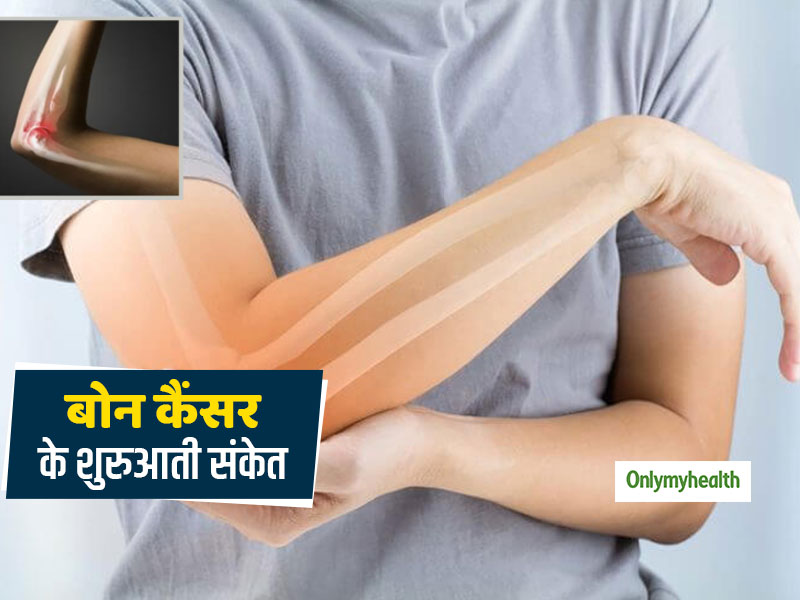 Bone Cancer Warning Signs: 10 से 30 साल के उम्र के बीच सबसे अधिक होता है बोन कैंसर, जानें इसके शुरुआती 7 संकेत 